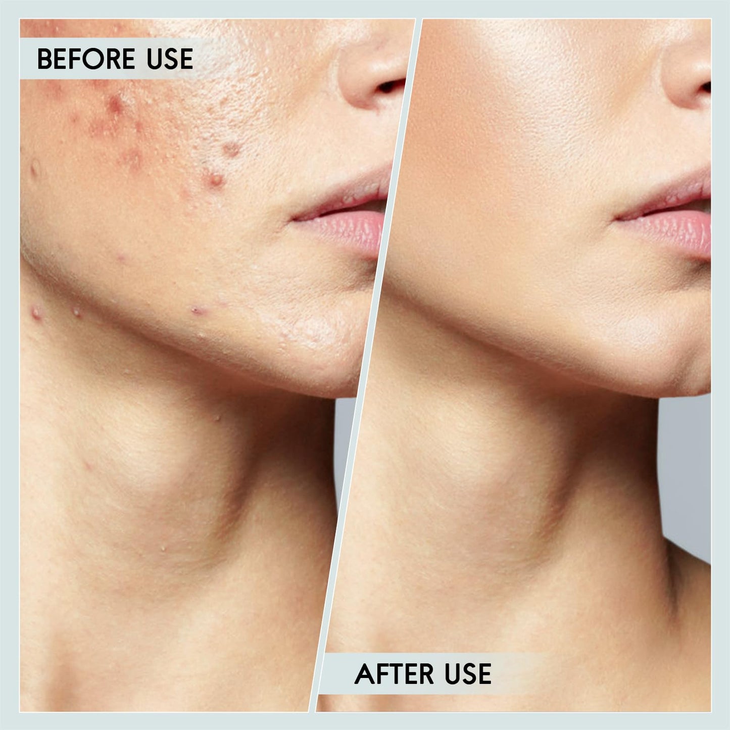 FEITA Blackhead Remover Pimple Popper Tool Kit, Comedone Pimple Extractor Acne Tools for Face Nose, Stainless Acne Needle Zit Popping Removal Facials Tool, Silver 4Pcs