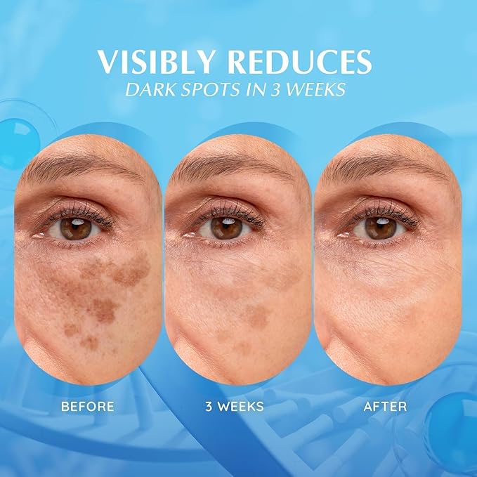 EnaSkin Dark Spot Remover for Face: Hyperpigmentation Body Treatment for Freckles Melasma Age Spot Sun Spot - Dark Spots Corrector Serum for Women and Men (1.0 Fl Oz)