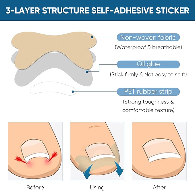 Ingrown Toenail Treatment, 60Pcs Ingrown Toenail