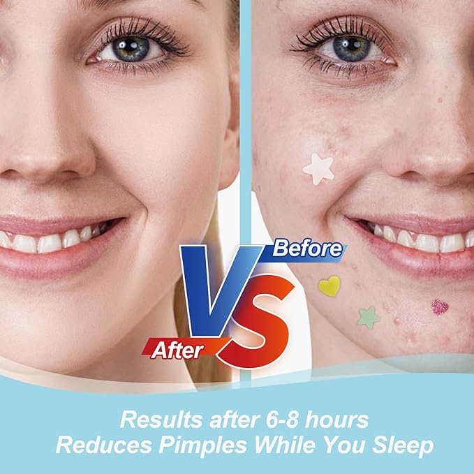 Star Pimple Patches for Face (120 Counts) Festival Beauty Party, Hydrocolloid Cute Acne Patches Cover Zits Blemishes, Zit Patches Spot Stickers Acid, Zit Patches Pads for Skin Care