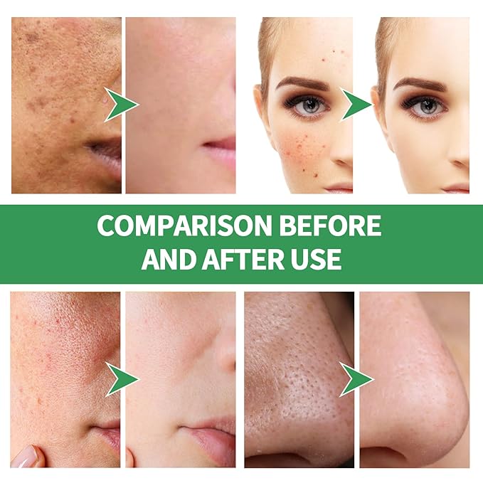 Centella Asiatica Bubble Face Mask, Centella Foam Facial Mask, Centella Bubble Facial Mask, Remove Black and Control Oil, Deeply Clean Facial (2)