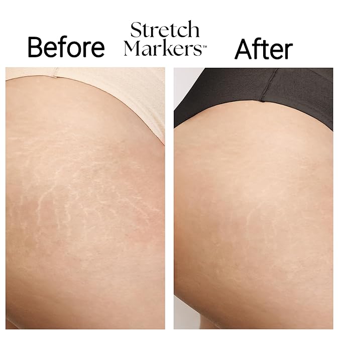 StretchMarkers Therapy Visibly Reduce and Treat Stretch Marks Cream, 1 fl oz, Retinol, Hyaluronic Acid, Bioactive Peptides & 3D Stem Cell Technology