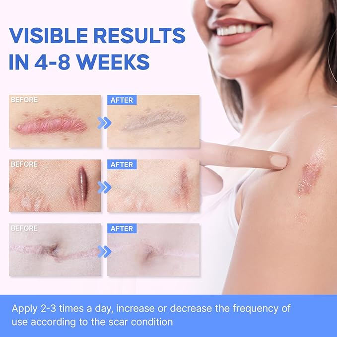Advanced Silicone Scar Removal Cream - Medical Grade Surgical Scars Gel for Face & Body - New & Old Scars Treatment for Acne, Burns & Surgery, Kids Over 6 Months, 1 oz
