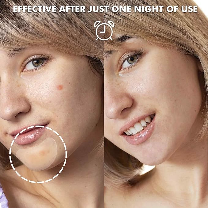 Albatross Health New England Large Acne Pimple Patches for Face, Chin, Back and Body (10 Counts), Spot Dots Cover, Hydrocolloid Treatment Stickers, Zit Blemish Patch