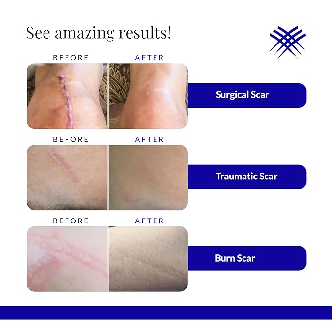 Rejuvaskin Scar Esthetique Scar Cream with Silicone, Reduces the Appearance of Surgical Scars, Burns, Stretch Marks, Keloids & Acne Scars, 60ml
