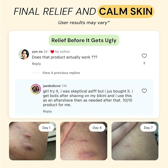 Universal Flare Care | Relief for 97% of Skin Issues | Cysts, Inflamed Skin, Hidradenitis Suppurativa, Abscesses, Impetigo | All Natural Flare Up Solution With Propolis & Egg Yolk Extract 4 oz