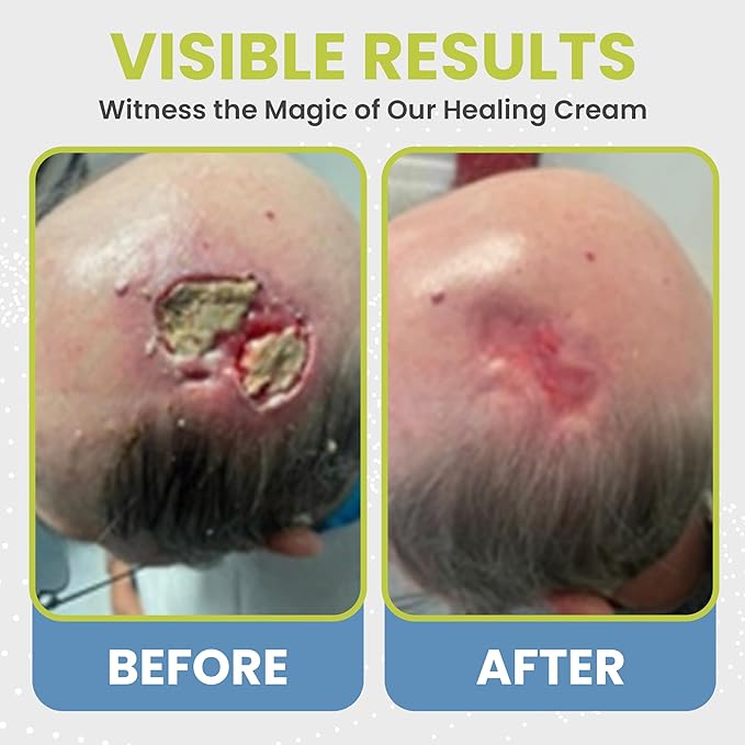 Skin Repair Wound Care Cream – 1 Oz Scar Prevention Cream First Aid Wound Ointment for Burns, Bites, Cuts, Ulcers, Abrasions – Deeply Nourishing Calendula Healing Ointment with Natural Ingredients