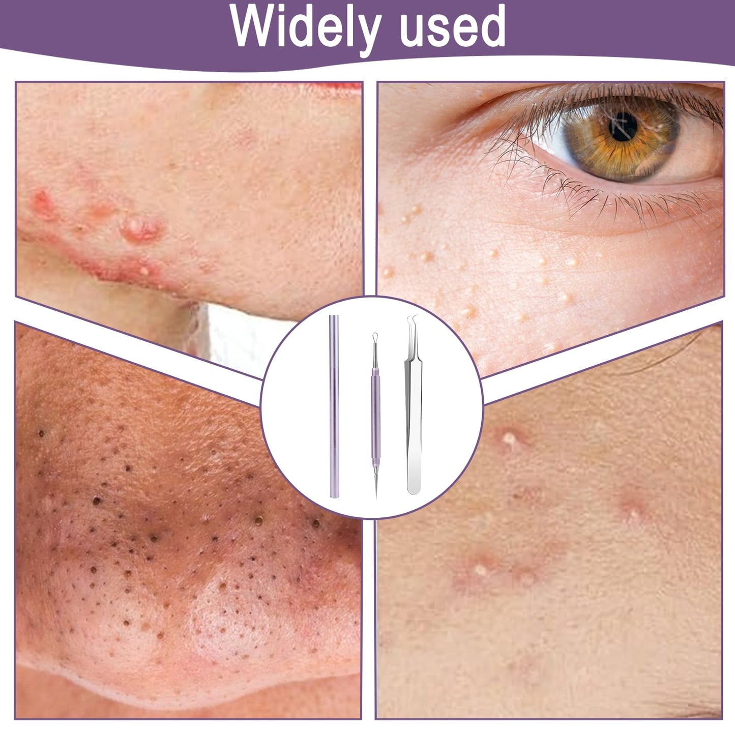 Nouiseuns Blackhead Tool Set for Face, Purple Stainless Steel Acne Extractor and Whitehead Extractor Tool – 2Pcs Professional Pimple Remover Kit with Angled Tweezers & Loop Needle for Nose & Skin Care