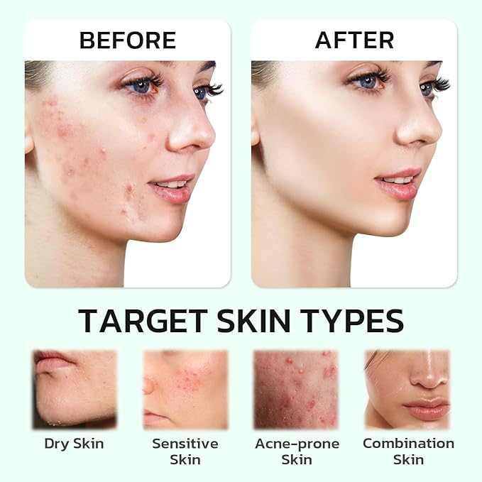 Centella Moisturizer Phytocin Cream Salmon PDRN Cream Face Soothing Hydration Barrier Repair Calming, for Acne Prone & Sensitive Skin with Ceramide, B5 (30ml)