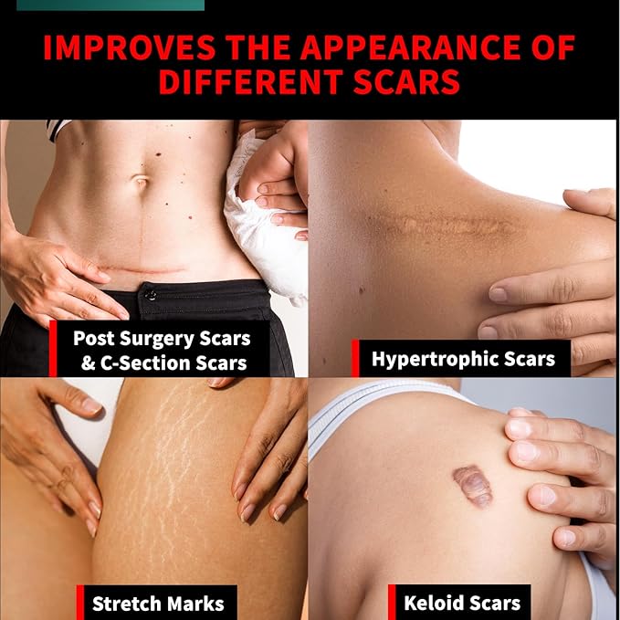 Protect Life Silicone Scar Cream for Surgical Scars, Injury & Keloid Scar Treatment, Moisturizing Scar Removal Cream, Rejuvenating Silicone Scar Gel