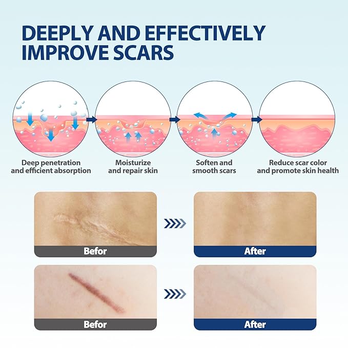 Scar Cream & Serum Oil, Advanced Scar Removal Set, Reduces Appearance of Keloids, C-Sections, Surgeries, Burns, Acne, 2 x 1.06 Oz Bottles