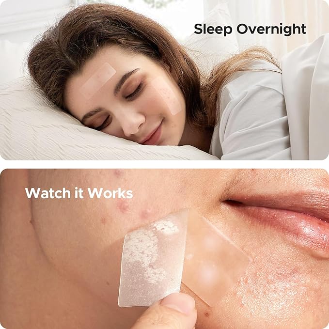 TKTK Large Pimple Patches, 60 mm XL Acne Patches, Big Hydrocolloid Bandages for Body, Face, Forehead, Chin, Neck Zit Breakouts, Hydrocolloid Patch (Square, Strip, Dot 5 Sizes 62 Count)