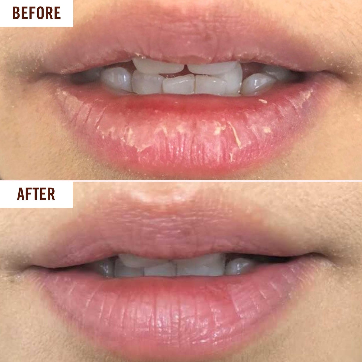 Hanalei Lip Treatment for Dry, Chapped Lips – Intensive Overnight Moisturizer with Kukui Oil, Shea Butter & Grapeseed Oil – Hydrating Balm for Healing Cracks – Clear Tint, Full-Size 15g – Cruelty-Free