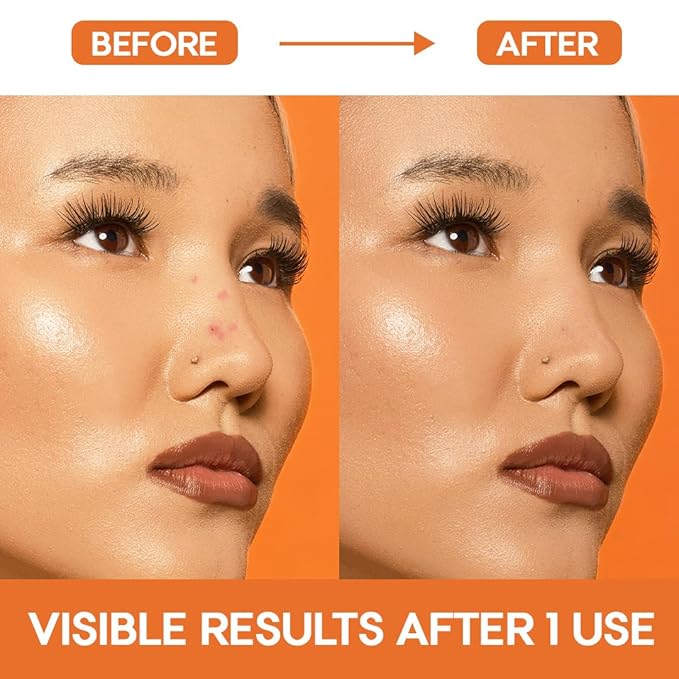 EZACNE™ Pimple Patches for Nose – Medical Grade Hydrocolloid Nose Pore Patches for Zits, Blemishes & Excess Oil – Overnight Pore & Whitehead Nose Strips (12 Count)