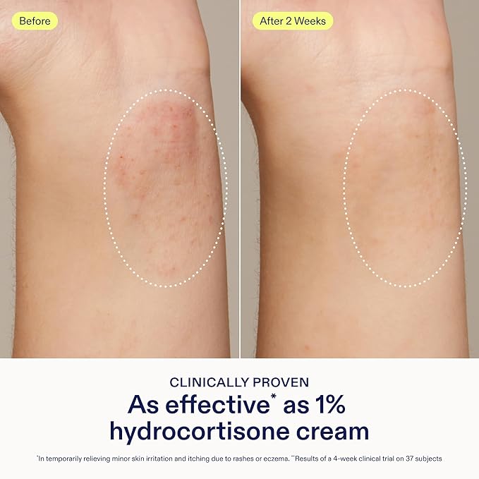 Skinfix Dermatitis Relief Balm - 1.7 fl oz - Proven Effective as 1% Hydrocortisone - Relieves Eczema & Itch - Accepted by the National Eczema Association - Steroid Free - Vegan, Cruelty Free