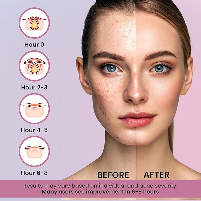 260Pcs Cute Pimple Patches for Face - Hydrocolloid Acne and Zit Patches - Blemish Stickers for Face Skin Care - Star, Heart, Cloud, Moon, Glitter & Regular Shapes, 7 Colors, 2 Sizes Stickers