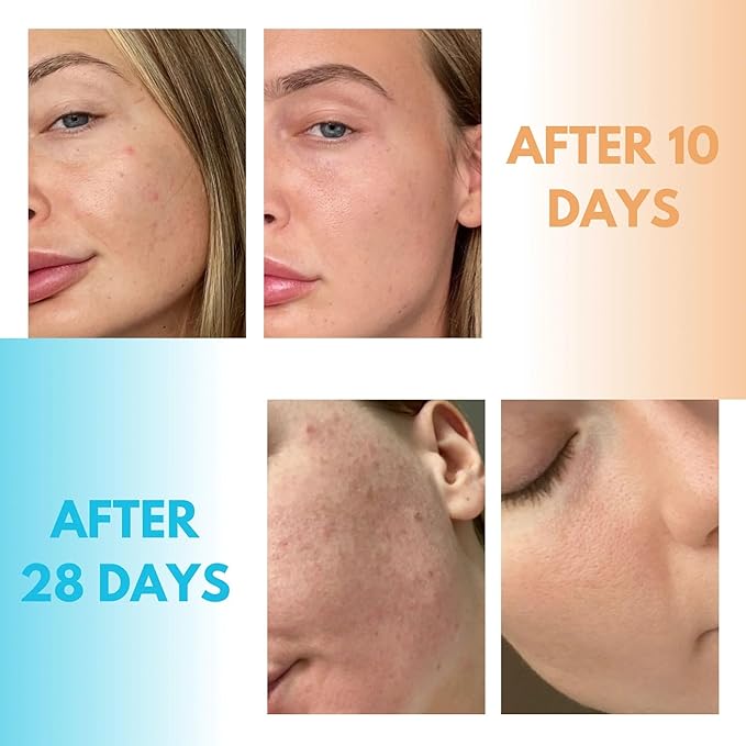 Derma Acne Duo – Complete Skincare Set with Cleansing Water & Pore Purifier for Clearer Skin