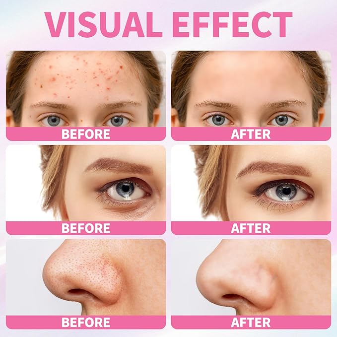 5 Step Skincare Kit with Cleanser, Face Scrub, Clay Mask,Toner & Acne Serum for Teens and Adults