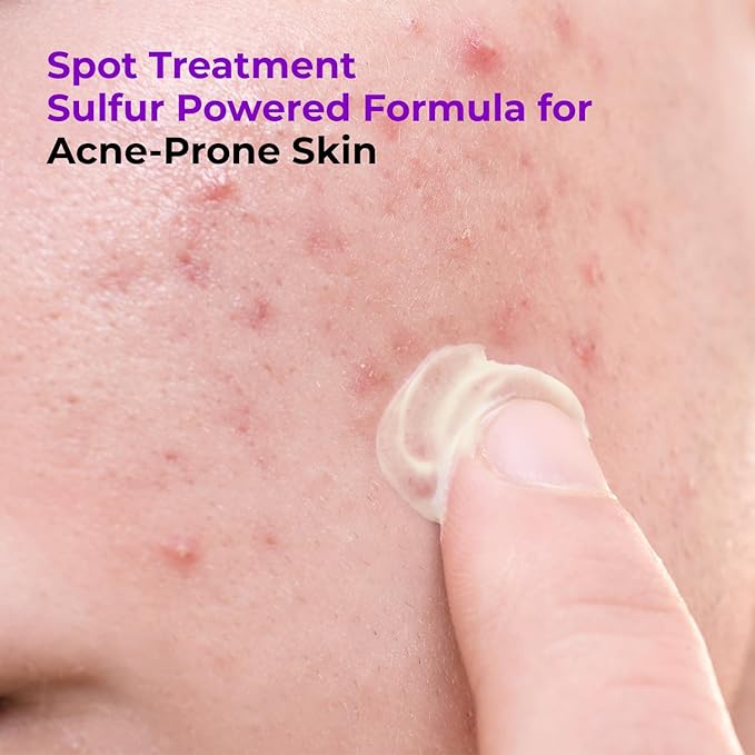 GLAM UP Spotless 10% Sulfur Treatment Spot Serum for Fast Healing Pimples, Blemishes and Acne Breakouts, Overnight Acne Soothing15mL, 0.5 fl. oz. [Made in the US]