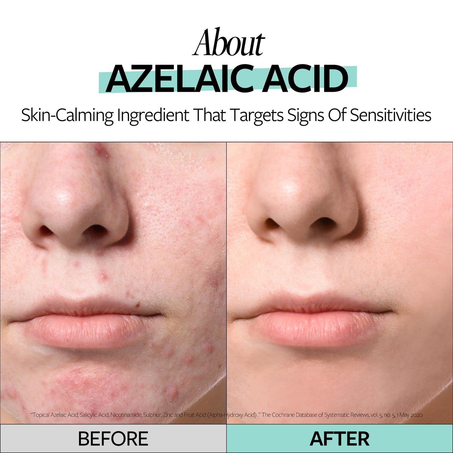 RECIPE Azelaic Acid 10 Soothing Ampoule - Soothing Serum, Facial Serum for Sensitive skin - Korean Skincare for Mild Breakouts (1.01 fl oz)