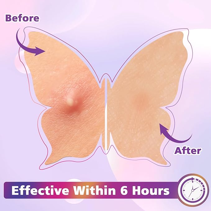 Acne Pimple Patches for Face (160 Counts), Hydrocolloid Acne Patches with Tea Tree Oil and Calendula Extract, Cute Colorful Butterfly Shape Spot Stickers for Skin Care, Zit Patches