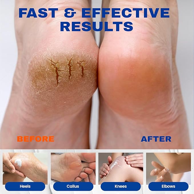 Urea Cream 40 Percent Plus 2% Salicylic Acid, 40% Urea Cream for Feet Maximum Strength, Foot Cream for Dry Cracked Feet, Heels, Knees, Hands & Elbows, Intensive Repair & Moisture, 5.29 oz