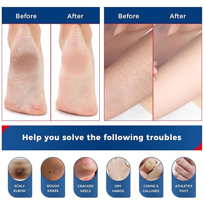 OUKEYA NEW FORMULA Urea Cream 40% Plus 2% Salicylic Acid for Feet Maximum Strength, Dry Cracked Hand Heel Moisturizing Repair Lotion for Knees, Elbows, Removes Corns, Dead Skin Cream, 5.29 oz