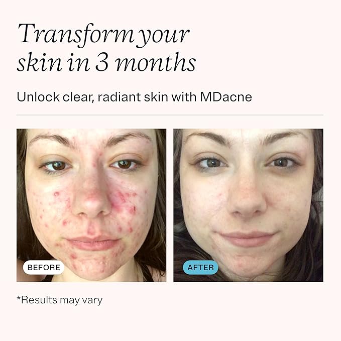 MDacne - Acne Treatment- Benzoyl Peroxide Cream 5% - Unclogs Pores, Reduces Blemishes & Enhanced with - Plant-Based Ingredients for Sensitive Skin