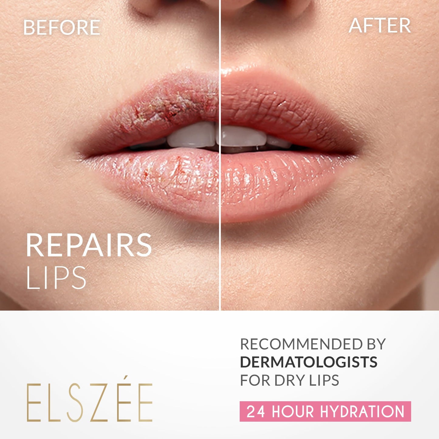 ELSZÉE Loveable Lips | Lip Mask with Hyaluronic Acid | Smooth, Volumize and Hydrate Dry Lips | Day & Night Treatment