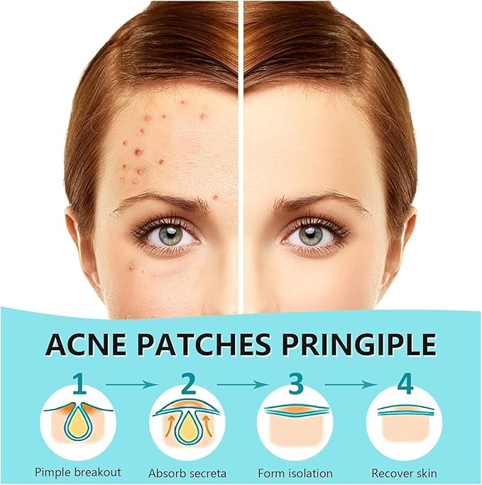Pimple Patches for Face, Hydrocolloid Acne Patches, Invisible Zit Patches for Face, Acne Spot Treatment Patch Cystic Blemish Patches Zit Stickers for all Skin Colors (360 Counts)