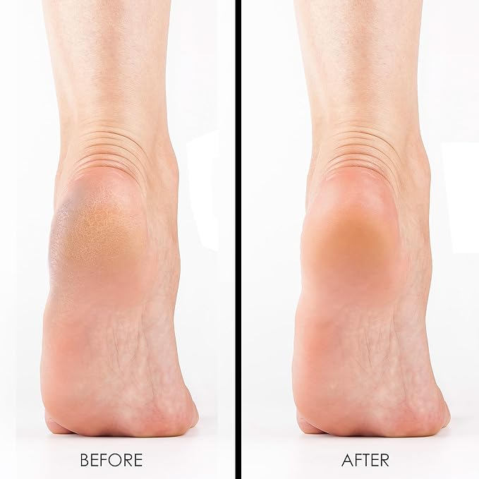 DeEnti Pumice Stones, Pack of