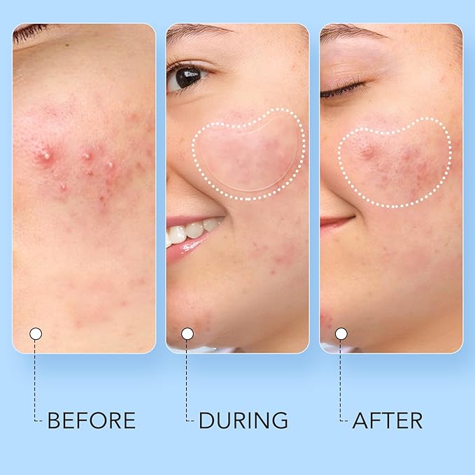 LitBear Acne Pimple Patch, 8 Sizes 140 Pcs Hydrocolloid Acne Patches with Storage Box, 24 XL Pimple Patches for Face, Chin, Nose, 4 Shapes Zits Patches for Blemish, dots with Tea Tree Oil & Cenrella