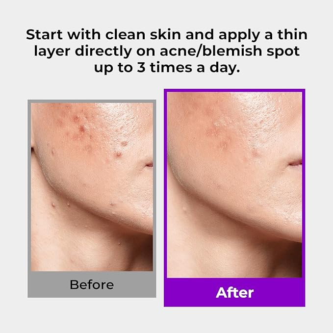 GLAM UP Spotless 10% Sulfur Treatment Spot Serum for Fast Healing Pimples, Blemishes and Acne Breakouts, Overnight Acne Soothing15mL, 0.5 fl. oz. [Made in the US]