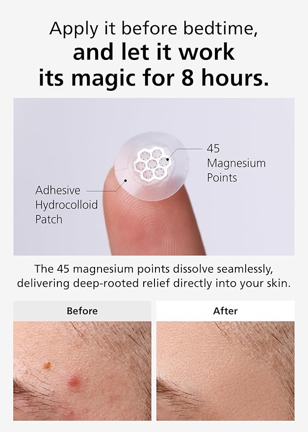 EasyDerm Quick Calming Magnesium Patches – 30 Patches Bulk Pack, Individually Wrapped Acne Care, Includes Tweezers & Ampoule, Korean Skincare, Made by Daewoong Pharmaceutical