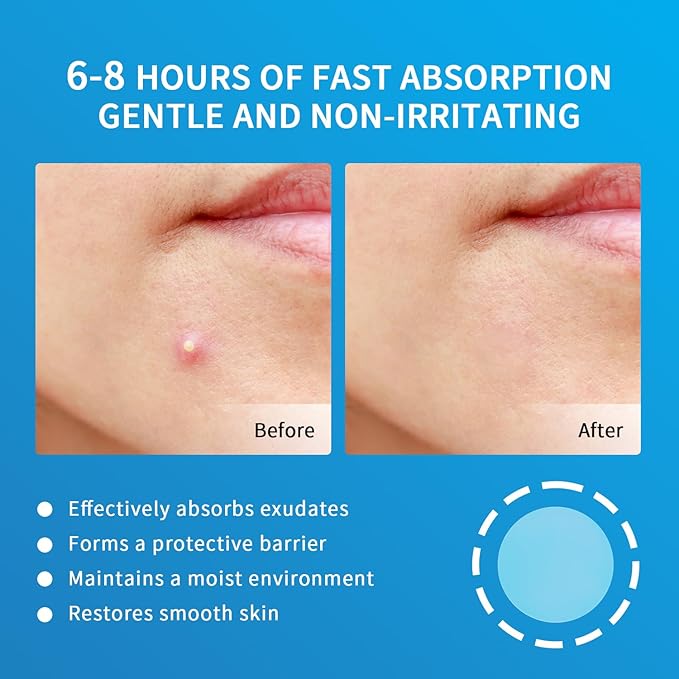 Pimple Patches for Face Hydrocolloid Acne Patches, Invisible Zit Stickers Covering Blemishes, 3 Size Hydrocolloid Spot Stickers for Face and Skin (144 Count(Pack of 1))