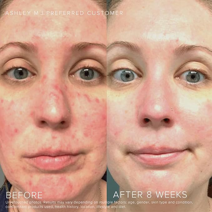 Rodan and Fields Soothe Regimen for Sensitive, Irritated Skin and Facial Redness