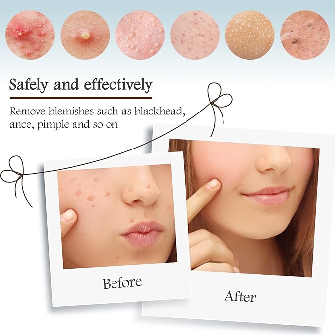 MORGLES Blackhead Remover Tools, 15 Pcs Pimple Popper Tool Kit Comedone Pimple Extractor for Blackhead Blemish Zit Removing with Metal Case 2024 Latest