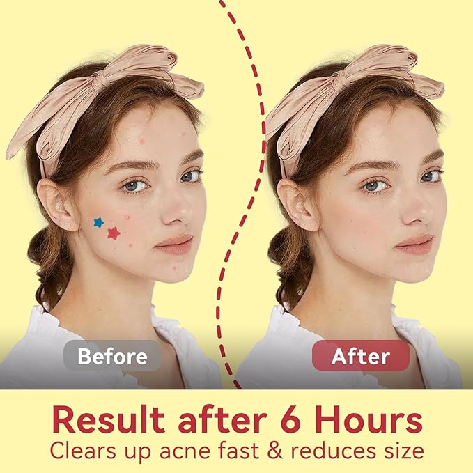 Star Pimple Patches for Face (66 patches) - Hydrocolloid Acne Blemish Pimple Patches Cute Stars, 6 Colors Stars ance patches, 14MM Sizes Zit Stickers