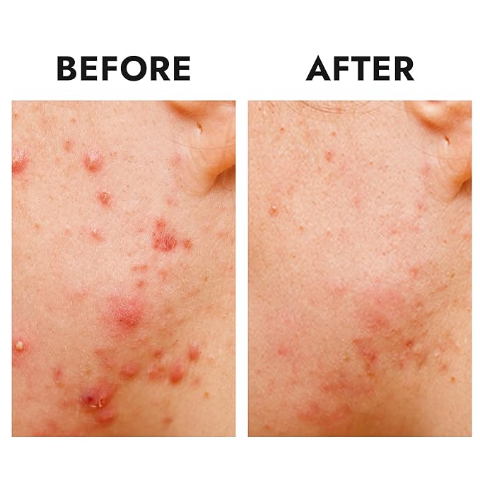 Epielle Over-Zit XL Acne Clear Patches | Ultimate Hydrocolloid Solution | 14 Extra-Large Pimple and Blemish Patches