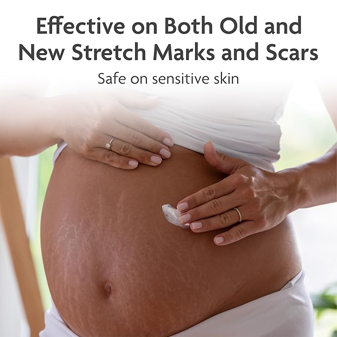 TriLASTIN Stretch Mark Cream for Pregnancy - 5.5 Oz Tube - Vitamin-Infused Cocoa Butter Formula - Intensive Scar Treatment - Hypoallergenic & Paraben-Free
