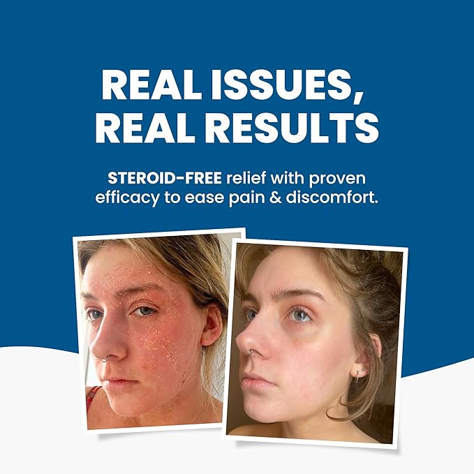 C+ Eczema Relief Cream - Steroid-Free Moisturizer Soothes Dermatitis, Inflammation, Redness Treatment for Irritated, Dry Skin - All Natural Ingredients with Manuka Honey, (4.23oz)