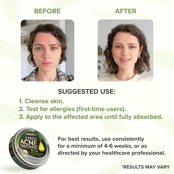 Cystic Acne Spot Treatment – Tea Tree Acne Cream – Fast-Acting Acne Spot Corrector for Face, Pimples & Blemishes – Non-Greasy, Gentle Formula – 1oz – by WELLUTION