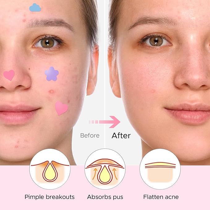 LitBear Acne Pimple Patch, 252 Dots 3 Shaped Colors Pimple Patches with Salicylic Acid, Tea Tree Oil & Calendula Oil, Hydrocolloid Acne Patch for Face, Blemish, Cute Zit Patch Pimple Sticker Acne Dots