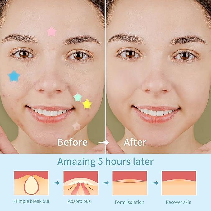 200 Counts Star Pimple Patches for Face, Hydrocolloid Acne Pimple Patches with Tea Tree Oil for Party Gift Covering Zits Blemishes