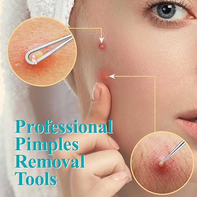 MORGLES Blackhead Remover and Pimple Popper Tool Kit, 10 Pcs Professional Acne Extractor Kit, Ingrown Hair Tweezers with Leather Travel Case for Face and Eyebrow Grooming