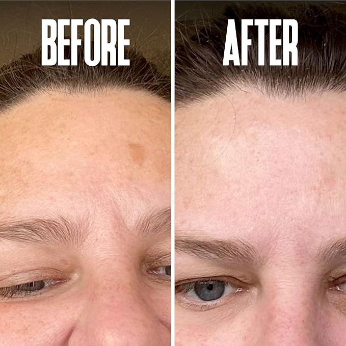 Dark Spot Corrector, Dark Spot Remover for Face - For Stubborn Dark Spots Serum, Dark Spot Remover with Kojic Acid, Alpha Arbutin, Mulberry Extract, Brightening Discoloration Correcting Serum