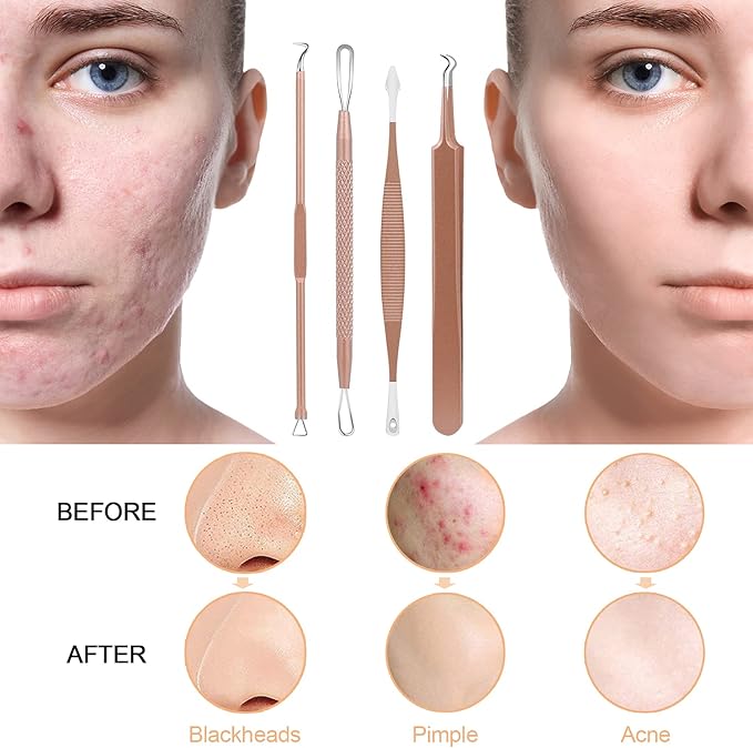 Pimple Popper Tool Kit, MENOLY 10 Pcs Blackhead Remover Comedone Extractor Acne Removal Kit for Blemish, Whitehead Popping,Zit Removing for Nose Face Tools with a Leather Bag (Rose Gold)