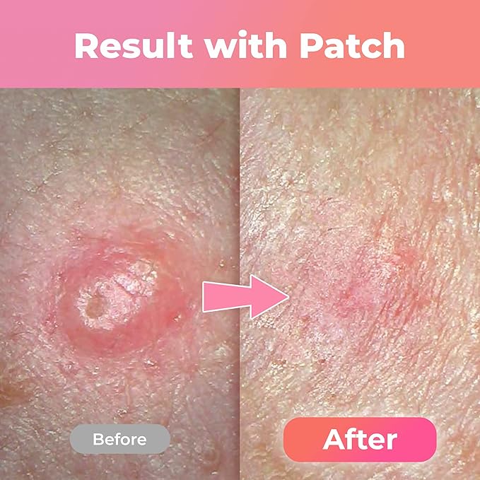 Amazing Patch - Korean Skin-tech Pimple Patch Invisible Spot Cover Over Night, Acne Patches for Face, Zit and Blemish Spot - 52ea