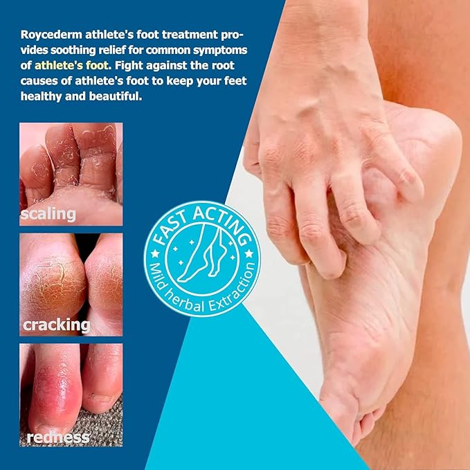 Roycederm Extra Strength Athletes Foot Treatment Cream - Powerful Antifungal Relief for Itching and Burning - Suitable for Men and Women
