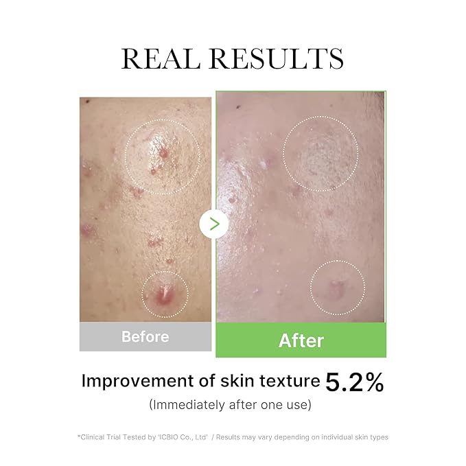 Medicube Exosome Cica Tea Tree Ampoule for Sensitive Skin with Centella Asiatica help reduce redness and breakouts. Low-irritating, Moisturizing & Soothing Serum | Korean Skincare | 30ml